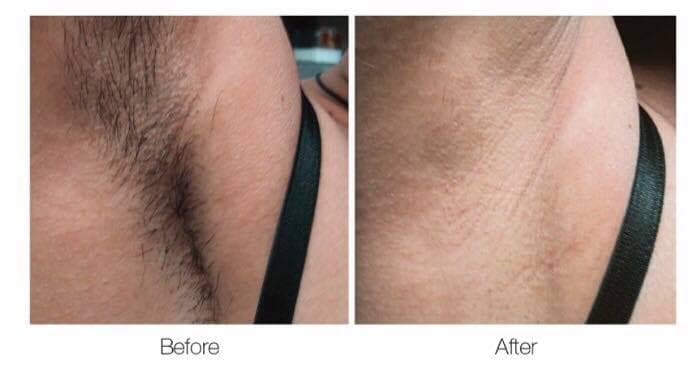 Laser Hair Removal Gore Laser Hair Removal Gore
