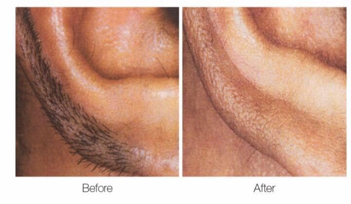 Laser Hair Removal Gore