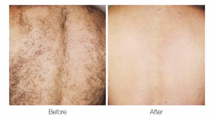 Laser Hair Removal Gore Laser Hair Removal Gore