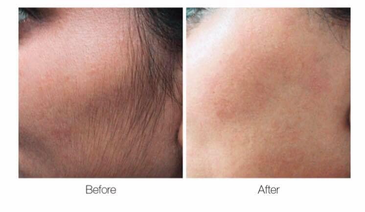 Laser Hair Removal Gore Laser Hair Removal Gore